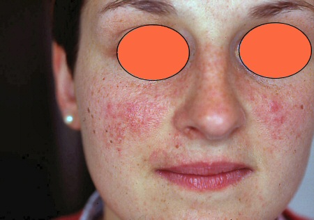 Subacute Cutaneous Lupus Erythematosus (SCLE): Background ...