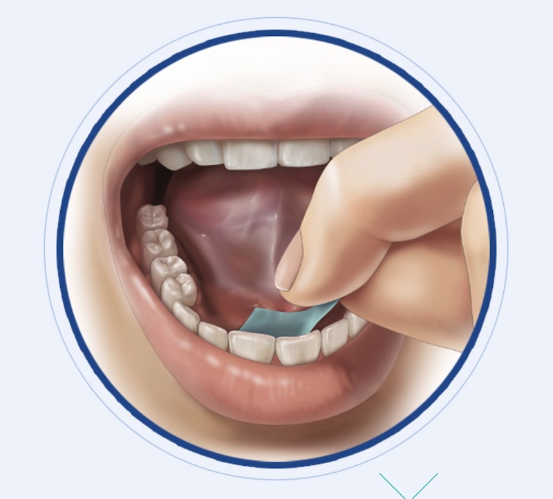 Anaphylm : le traitement sublingual de l’anaphylaxie
