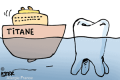 Les dentistes s'intéressent à l'allergie au titane…